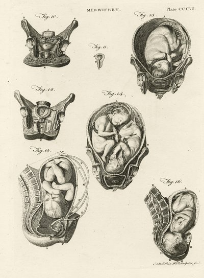 Geburtshilfe, Illustration aus 